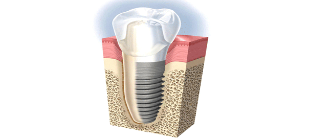 Dental Implants